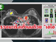 นักวิทยาศาสตร์พัฒนาเครื่องมือวินิจฉัยมะเร็งเต้านมด้วยระบบ AI
